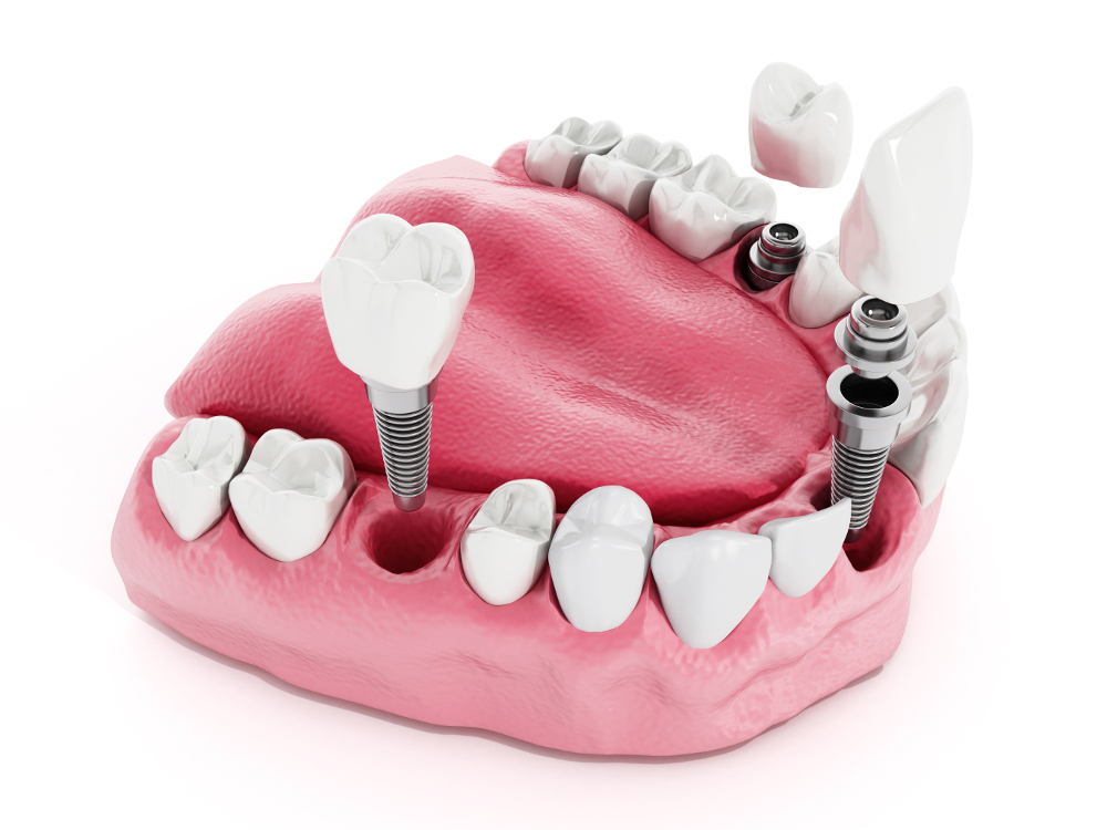 Die hochmoderne Implantat-Prothetik in der Marburger Zahnarztpraxis von Guido Schwalm sorgt für Sicherheit und Stabilität
